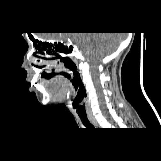 Carcinoma of the maxillary antrum (Radiopaedia 53805-59888 Sagittal C+ delayed 93).jpg