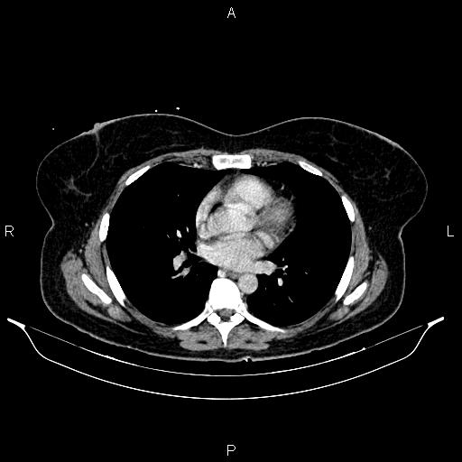 Carcinoma of uterine cervix (Radiopaedia 85861-101700 A 21).jpg