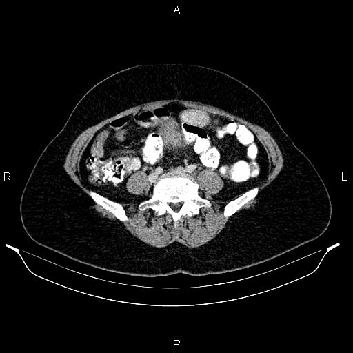 File:Carcinoma of uterine cervix (Radiopaedia 85861-101700 A 58).jpg