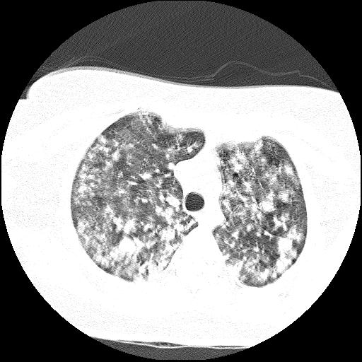 Cardiac angiosarcoma (Radiopaedia 66010-75181 Axial lung window 69).jpg