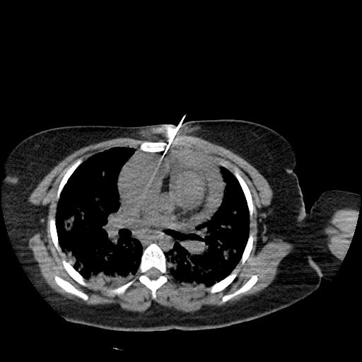 File:Cardiac angiosarcoma (Radiopaedia 66010-75388 Axial 1).jpeg