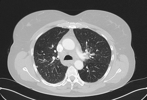 File:Cardiac sarcoidosis (Radiopaedia 74548-85534 Axial lung window 30).jpg