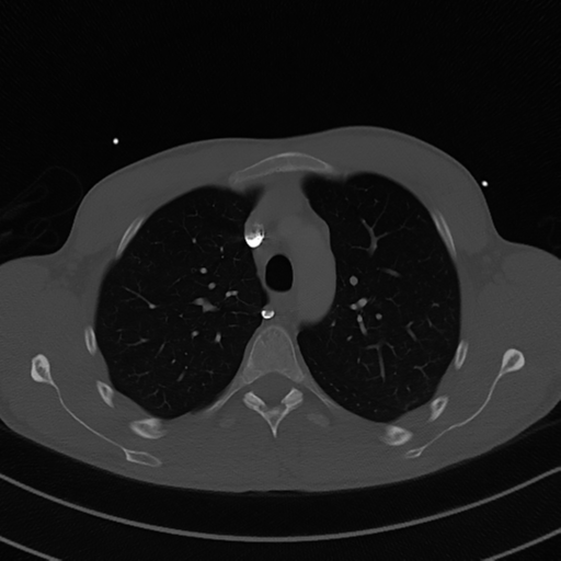 Cardiac tumor - undifferentiated pleomorphic sarcoma (Radiopaedia 45844-50134 Axial bone window 20).png