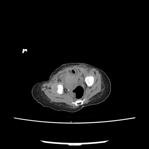 File:Caroli disease with autosomal recessive polycystic kidney disease (ARPKD) (Radiopaedia 89651-106703 E 213).jpg