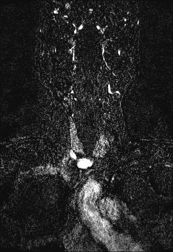 Carotid artery dissection (Radiopaedia 28441-28689 Coronal MRA 17).jpg