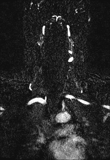 Carotid artery dissection (Radiopaedia 28441-28689 Coronal MRA 48).jpg