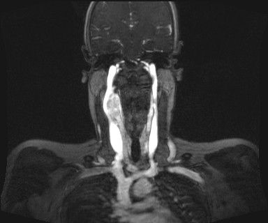 Carotid body tumor (Radiopaedia 12777-12912 MRA 36).jpg