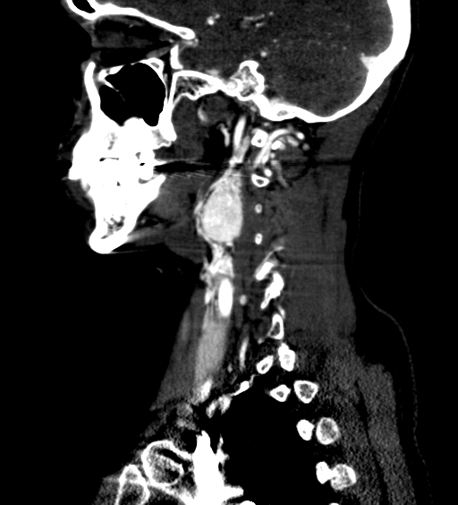 File:Carotid body tumor (Radiopaedia 39845-42300 D 43).jpg