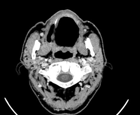 Carotid body tumor (Radiopaedia 61750-69757 Axial Post contrast 13).jpg
