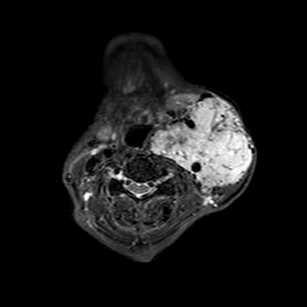 File:Carotid body tumor (Radiopaedia 7571-8398 Axial T1 C+ fat sat 1).jpg