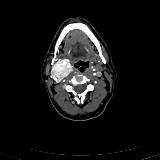 Carotid body tumor (Radiopaedia 83615-98727 A 53).jpg