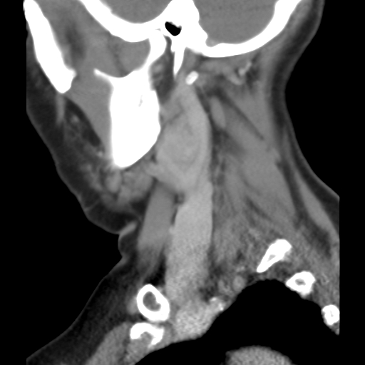 File:Carotid body tumor (paraganglioma) (Radiopaedia 38586-40729 C 22).jpg