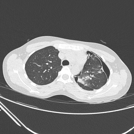 Catamenial pneumothorax (Radiopaedia 27946-28197 lung window 55).jpg