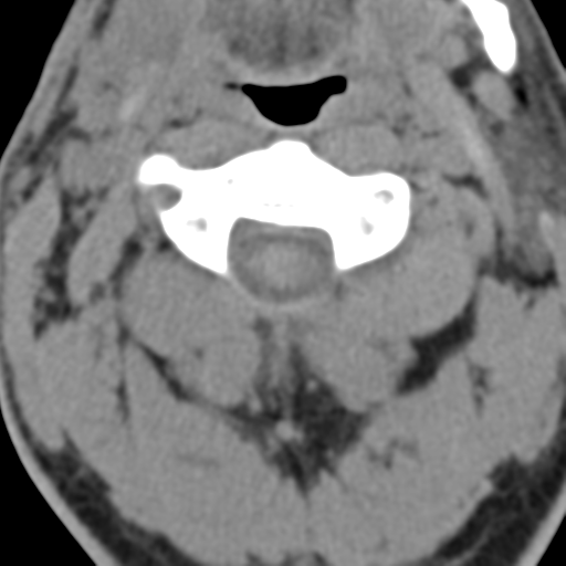 File:Cavernoma of cervical cord (Radiopaedia 50838-56346 Coronal non-contrast 4).png