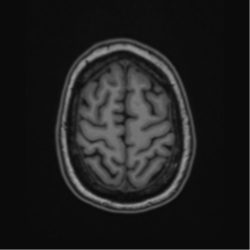 Cavernoma with bleed - midbrain (Radiopaedia 54546-60774 Axial T1 48).png