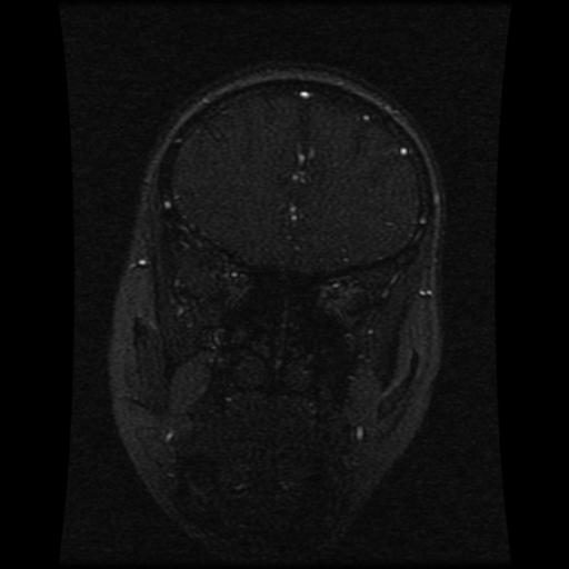 Cavernoma with developmental venous anomaly (Radiopaedia 22470-22507 MRV 96).jpg