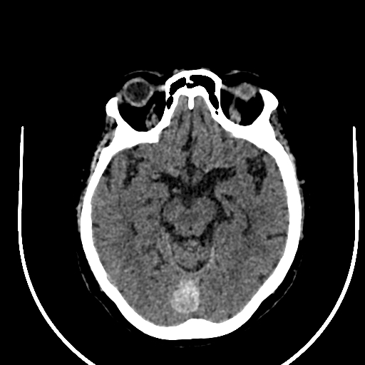 Cavernous hemangioma of the cerebellar falx (Radiopaedia 73025-83723 Axial non-contrast 56).jpg
