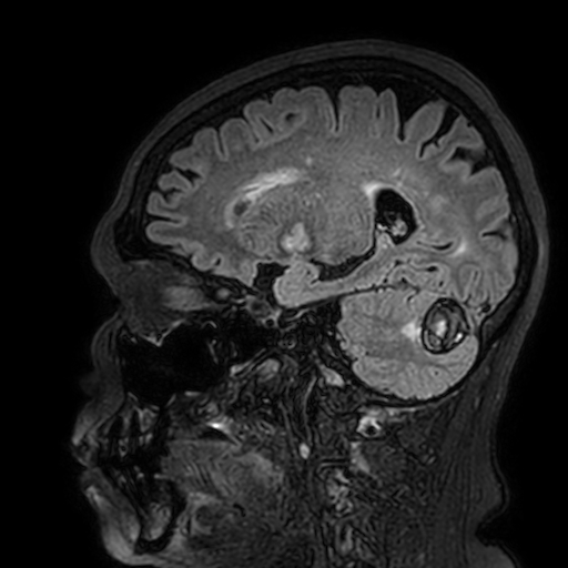 File:Cavernous hemangioma of the cerebellar falx (Radiopaedia 73025-83724 Sagittal FLAIR 73).jpg