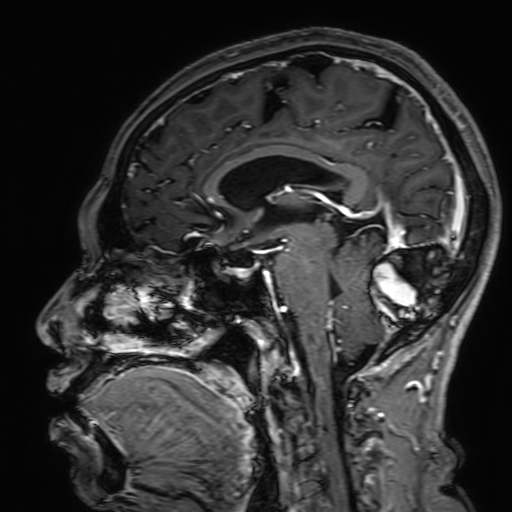 File:Cavernous hemangioma of the cerebellar falx (Radiopaedia 73025-83724 Sagittal T1 C+ 102).jpg