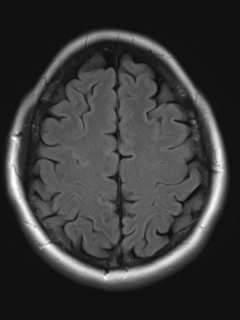 File:Cavernous malformation (cavernous angioma or cavernoma) (Radiopaedia 36675-38237 Axial T2 FLAIR 17).png