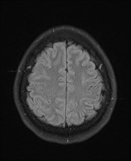 File:Cavernous sinus meningioma (Radiopaedia 63682-72367 Axial FLAIR 18).jpg