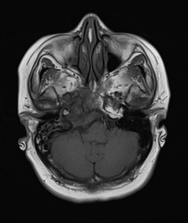 File:Cavernous sinus meningioma (Radiopaedia 63682-72367 Axial T1 5).jpg
