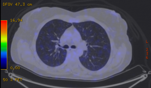 File:Cavitating lung mass - squamous cell carcinoma (Radiopaedia 48047-52853 A 40).png