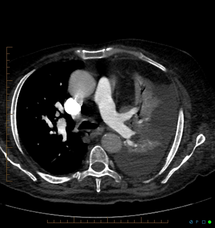 Cavitating pulmonary infarction (Radiopaedia 54634-60849 Axial C+ CTPA 30).jpg