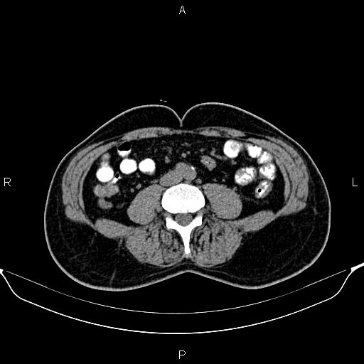 Cecal adenocarcinoma (Radiopaedia 85324-100916 Axial non-contrast 57).jpg