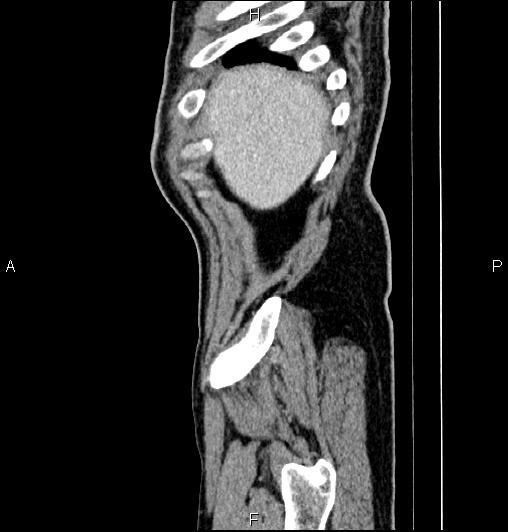 Cecal adenocarcinoma (Radiopaedia 85324-100916 E 7).jpg