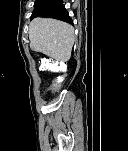 File:Cecal cancer with appendiceal mucocele (Radiopaedia 91080-108651 E 13).jpg