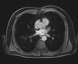 Cecal mass causing appendicitis (Radiopaedia 59207-66532 T1 C+ PV phase 4).jpg