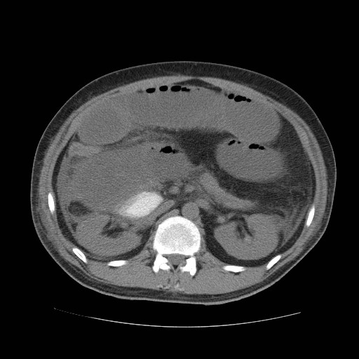 Cecal volvulus (Radiopaedia 28294-28534 Axial non-contrast 32).jpg