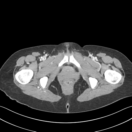 Cecum hernia through the foramen of Winslow (Radiopaedia 46634-51112 A 77).png