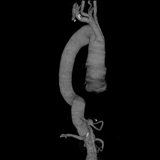 File:Celiac artery aneurysm (Radiopaedia 21574-21525 C 16).JPEG