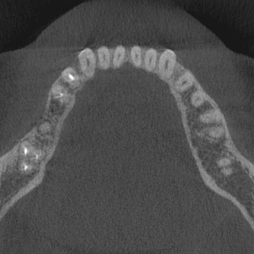 Cemento-osseous dysplasia (Radiopaedia 48251-53126 Axial non-contrast 41).jpg