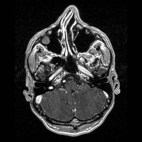 Central-variant posterior reversible encephalopathy syndrome (PRES) (Radiopaedia 43880-47358 Axial T1 C+ 25).jpg