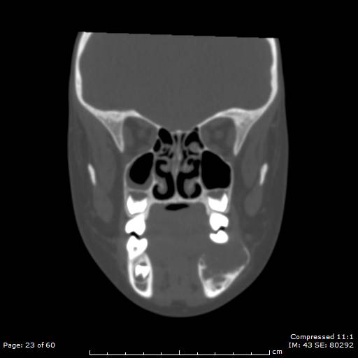 Central giant cell granuloma (Radiopaedia 45612-49754 Coronal bone window 23).jpg