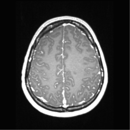 Central neurocytoma (Radiopaedia 37664-39557 Axial T1 C+ 61).png