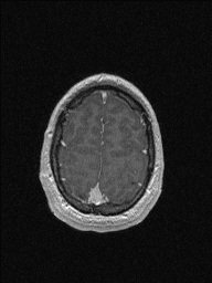 Central neurocytoma (Radiopaedia 56690-63469 Axial T1 C+ 144).jpg