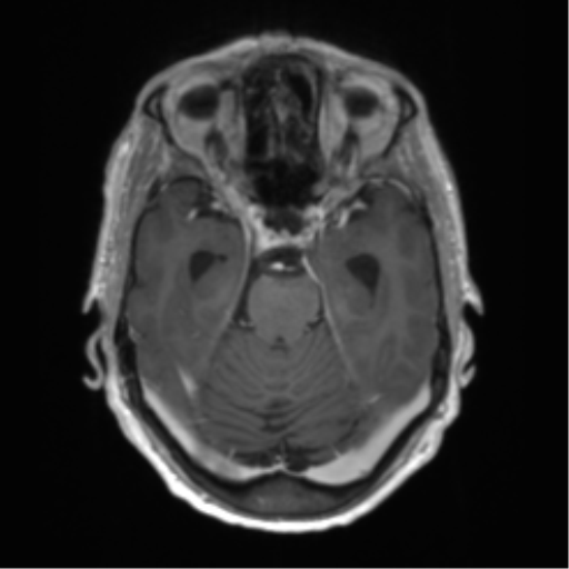 Central neurocytoma (Radiopaedia 65317-74345 Axial T1 C+ 16).png