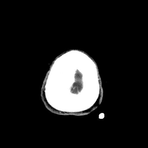 Central neurocytoma (Radiopaedia 68725-78432 Axial C+ 88).jpg
