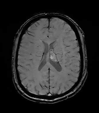 File:Central neurocytoma (Radiopaedia 71068-81303 Axial SWI 39).jpg
