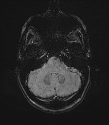 Central neurocytoma (Radiopaedia 84497-99872 Axial SWI 15).jpg