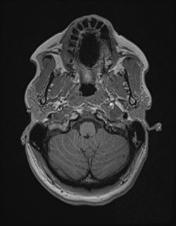 Central neurocytoma (Radiopaedia 84497-99872 Axial T1 36).jpg