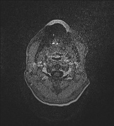 Central neurocytoma (Radiopaedia 84497-99872 Axial T1 C+ 1).jpg