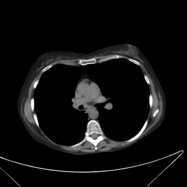 Centrilobular pulmonary emphysema (Radiopaedia 24495-24789 Axial non-contrast 24).jpg