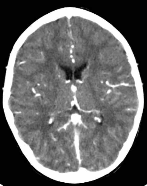 Cerebellar abscess (Radiopaedia 73727-84527 Axial C+ 47).jpg
