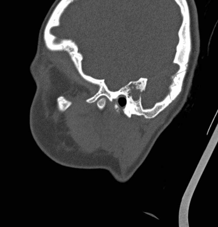 Cerebellar abscess (Radiopaedia 73727-84527 Sagittal bone window 32).jpg