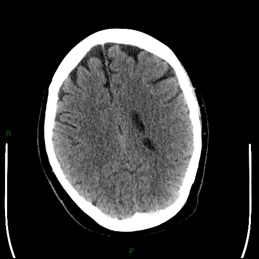 Cerebellar abscess (Radiopaedia 78135-90671 Axial non-contrast 73).jpg